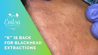 K Is Back for Blackhead Extractions