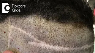 How long do transplanted hair last? - Dr. K Prapanna Arya