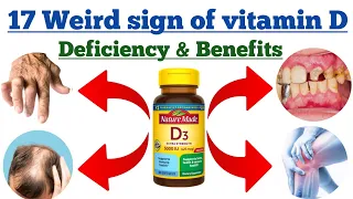 Benefits of vitamin D and 17 weird sign of vitamin D deficiency