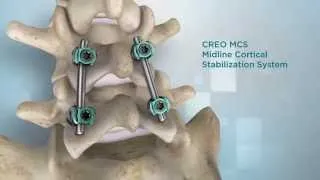 Globus Medical: CREO MCS™