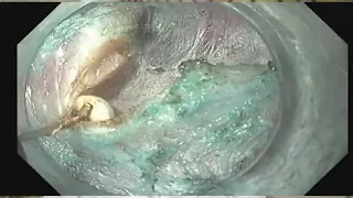 Case Presentation | Gastric Peroral Endoscopic Myotomy (GPOEM) for Gastroparesis