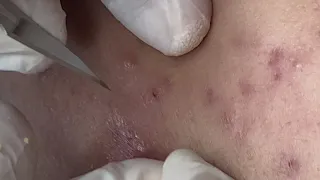 Extractions And Acne  - ThuyTruong#104