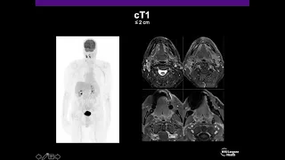 Imaging Naso and oropharyngeal carcinoma