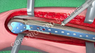 Broken Leg Surgery Femur Fracture Animation