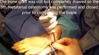 Evans calcaneal osteotomy for flat foot (Collapsing Pes Valgo Plannus)