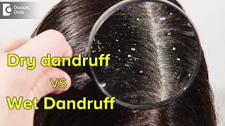 Dry dandruff vs Wet dandruff | How to recognize and treat them?-Dr. Rashmi Ravindra|Doctors' Circle