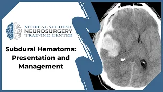 Subdural Hematoma: Presentation and Management