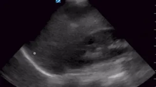 Mirror Artifact At A Normal Lung Base