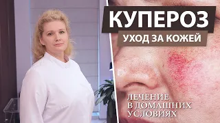 Лечение купероза на лице в домашних условиях. Купероз - что это?