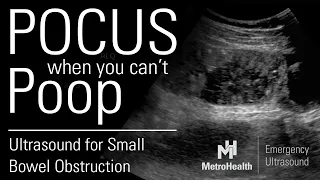 POCUS When You Can't Poop:  The Ultrasound Evaluation of Small Bowel Obstruction