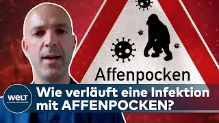 „Sollten Affenpocken nicht mit der Coronavirus-Pandemie vergleichen“ - VIROLOGE SCHMIDT-CHANASIT