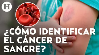 ¿Moretones en la piel sin razón aparente? Así puedes saber si se trata de cáncer de sangre