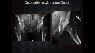 Radiography of Arthritis,  2018 Refresher