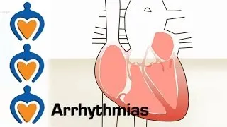 Arrhythmias - What is an arrhythmia and how is it treated?