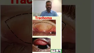 clinical manifestations of trachoma. to watch full video click on link given in comments section