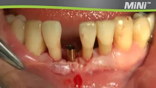 Mega'Gen MiNi implant placement - Clinical Case Video #2