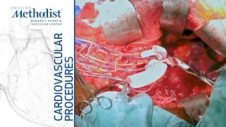 Type IV Thoracoabdominal Aortic Aneurysm Repair (Lumsden MD; MacGillivray MD; Zubair MD; Livingston)