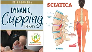 Dynamic Cupping for sciatica Pain