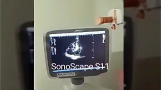 SonoScape S11 with Echocardiography