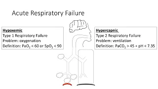 Acute Respiratory Failure