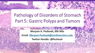 Part 5- Pathology of Gastric Disorders-  polyps and Tumors