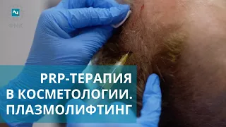 💉 Эффективное омоложение плазмой: плазмолифтинг и PRP-терапия в косметологии. Плазмолифтинг PRP. 18+