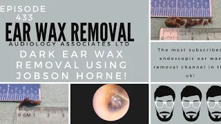 DARK EAR WAX REMOVAL USING JOBSON HORNE - EP 433