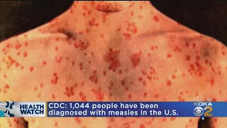 Measles Cases On The Rise Nationwide