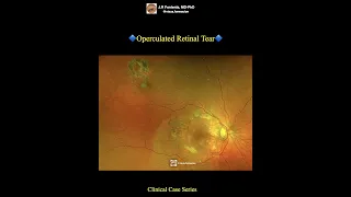 Operculated Retinal Tear.