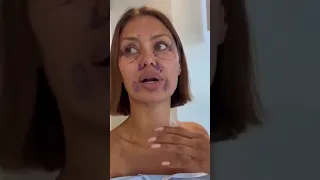 Боня боится смотреть на себя в зеркало после операции на лице