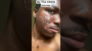 My TCA CROSS journey #skincare #skinscars #acnetreatment #tcapeel #acne #acnetreatment