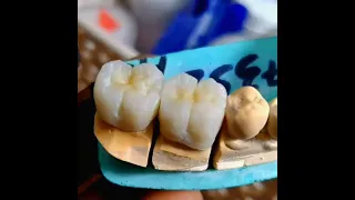 zirconia crown 🦷 good quality work