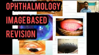 Ophthalmology Images | Ophthalmology Revision (Part-1) for NeetPG, FMGE, NEXT and UPSC CMS