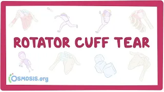 Rotator cuff tears - an Osmosis Preview