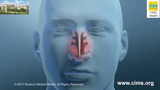 Nasal Turbinate Reduction – CIMS Hospital