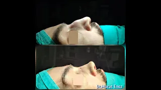 Dropped Nose Tip After Septoplasty and Open Technique Septorhinoplasty Operation