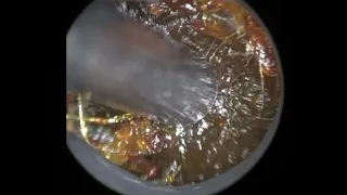 12 - Crystal Clear Ear Wax Removal with the WAXscope®️