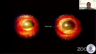 Walk in Retina Patient in your OPD: Intravitreal Injections in Endophthalmitis by Dr Pritam Samat