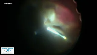 LARGE INTRA OCULAR FOREIGN BODY: TWO STEP PROCEDURE