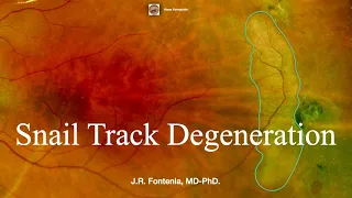 Snail Track Degeneration. Peripheral Retinal Degenerations.