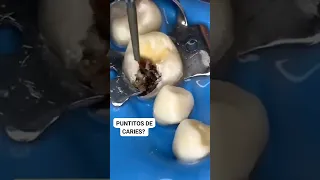 LO ENGAÑOSO DE LA CARIES DENTAL #shorts #youtubeshorts #dentista #viral