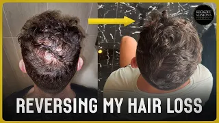 How I Reversed My Hair Loss | 1 Year Transformation | NO HAIR TRANSPLANT