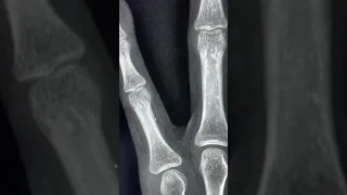 Potential pitfall for the fracture on plain radiographs