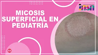 Micosis Superficial en Pediatría - Tele IEC