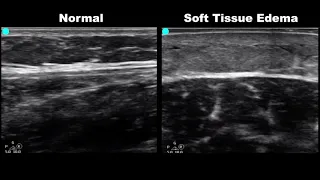 POCUS - Soft Tissue Ultrasound - Subcutaneous Air