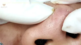 Pop acne,blackheads in nose,cyst skillfully at Hien Van Spa-411-Ngọc Trâm