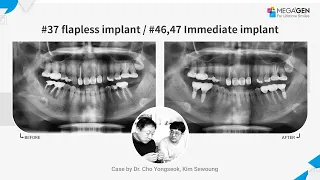Dr. Yongseok CHO, Sewoung KIM, #37 flapless implant #46, 47 Immediate implant surgery and prosthesis