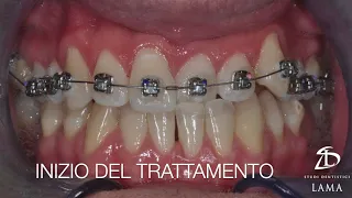 Trattamento ortodontico di Morso Inverso Anteriore con un apparecchio dentale fisso