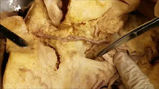 Facial Muscles Dissection – Black Eye – Buccal Fat – Bells Palsy – Sanjoy Sanyal