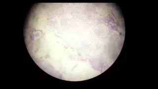 transitional cell carcinoma histopathology